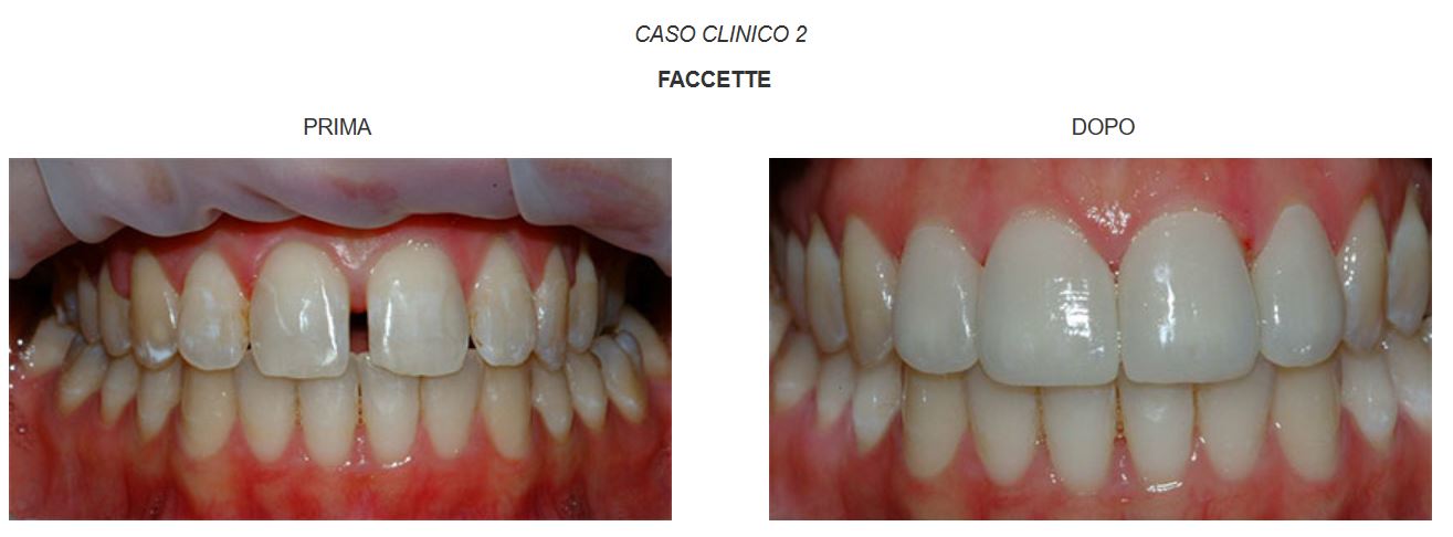 faccette-dentali