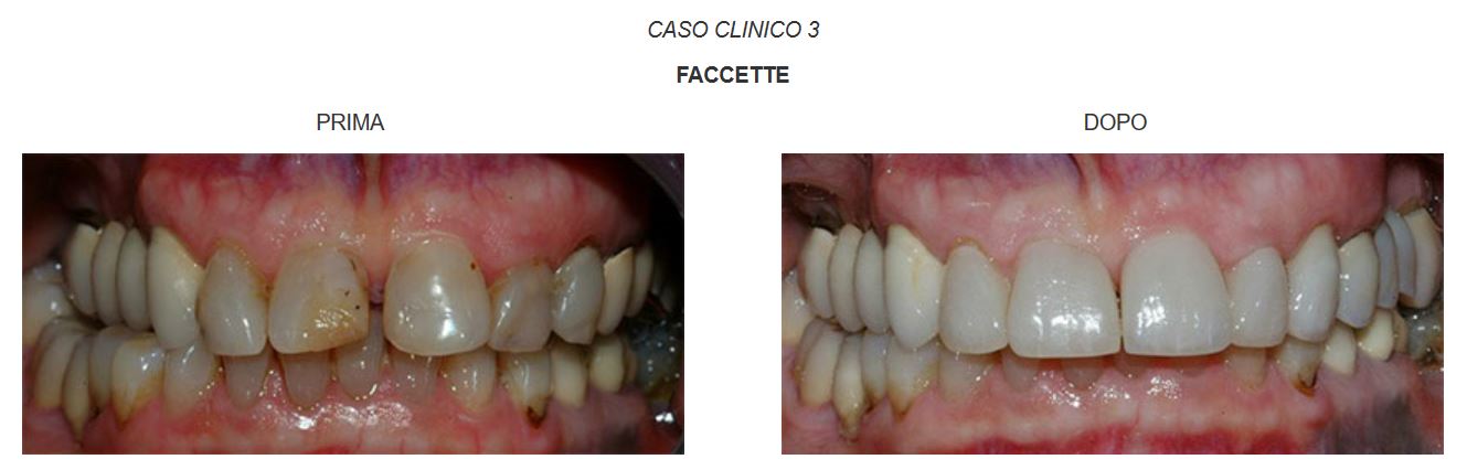 faccette-estetiche