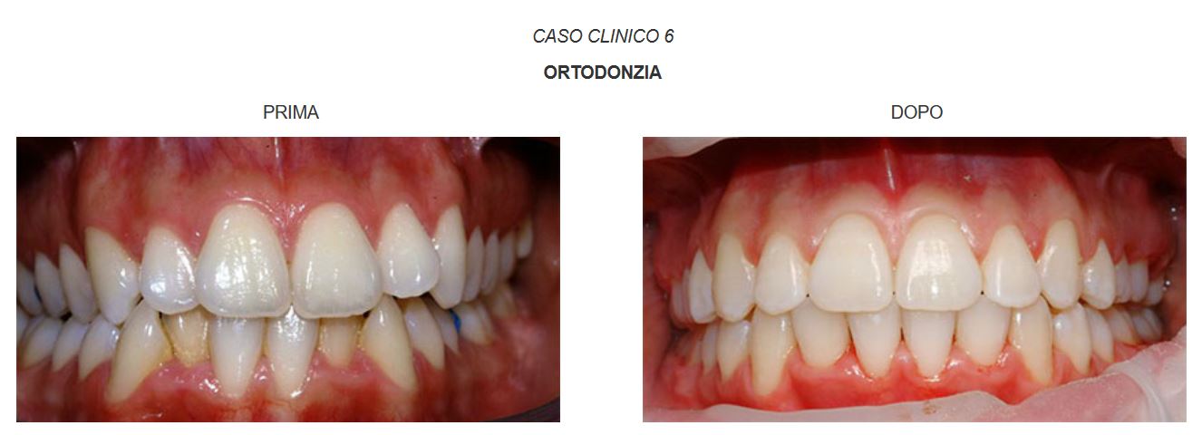 ortodonzia-caso